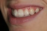 Cosmetic Bonding