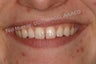 Cosmetic Bonding to close space