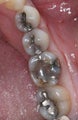 Mercury Silver filling replacement