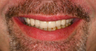Full Porcelain Crowns