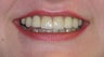 Crowns and implants