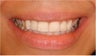 Two poorly matching crowns replaced