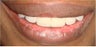 6 dental crowns to repair badly broken down teeth