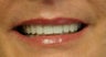 porcelain crowns
