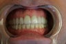 porcelain crowns