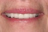 New Porcelain Crowns