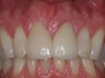 Anterior Crowns