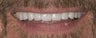 Porcelain Crowns 