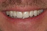 Tooth replacement in the smile