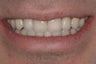 Full Mouth Reconstruction