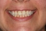 Dental Crown