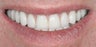 Porcelain veneers and crowns