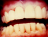 Dental Crowns
