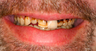 Full Porcelain Crowns