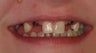 Crowns and implants