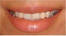 Two poorly matching crowns replaced