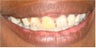 6 dental crowns to repair badly broken down teeth