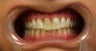 porcelain crowns