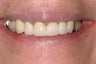 New Porcelain Crowns