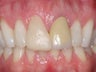 Anterior Crowns