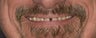 Porcelain Crowns 