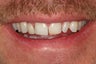 Tooth replacement in the smile