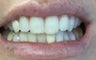 Dental Crown
