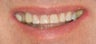 Porcelain veneers and crowns