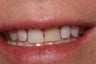 One Single Porcelain Crown