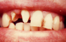 Dental Crowns