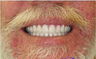 Dentures