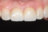 Single implant and crown in smile zone