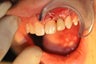 Dental implant replacement of missing incisor