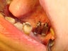 Molar replacement with 2 implants