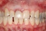Single implant and crown central incisor