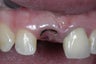 Single implant and crown in smile zone