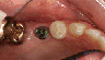 Implants