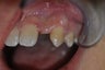 Dental implant replacement of missing incisor