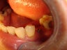 Crown placement on dental implant