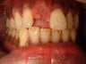 Trauma case. Implant to replace an avulsed tooth