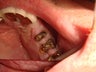Bridge failure and subsequent implant fixed bridge treatment