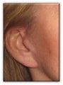 Ear Lobe Surgery