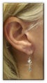 Ear Lobe Surgery