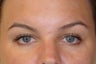Dysport Injections