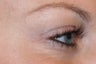 Dysport injections for Crow's Feet