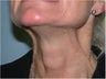 Dysport  treatment of neck Bands
