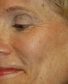 Dysport - The BOTOX Alternative