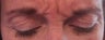 Frown lines treatment