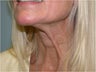Dysport  treatment of neck Bands