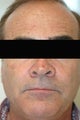 Dysport (Botox) for Forehead Wrinkles, Los Angeles, CA